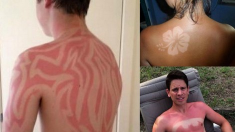Nevaren Twitter trend: Tatuji iz sončnih opeklin!