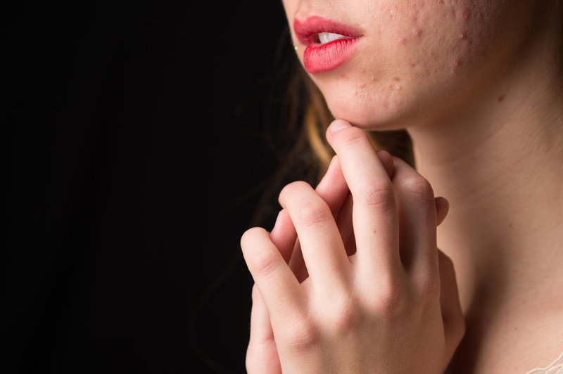 Trpiš zaradi aknaste kože? Pozor, ta dejavnik lahko tvoje stanje še poslabša! (foto: Profimedia)