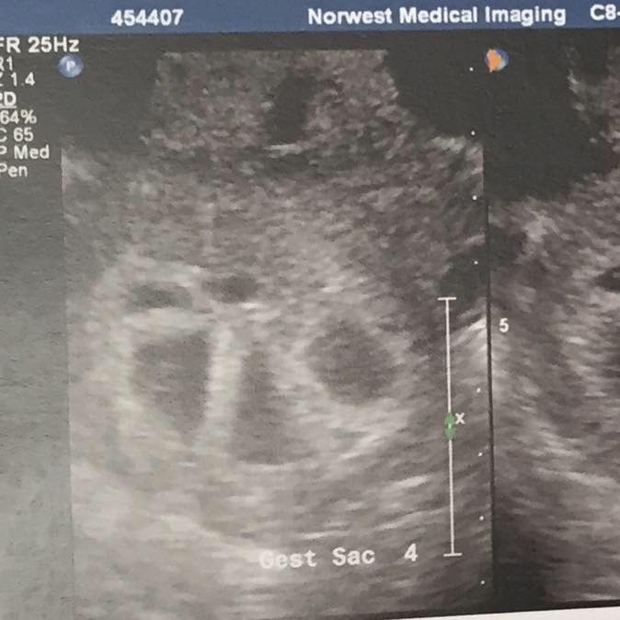 facebook stran Surprised by Five, na kateri je objavila tudi prvi ultrazvok. Kmalu so na svet privekali malčki ...