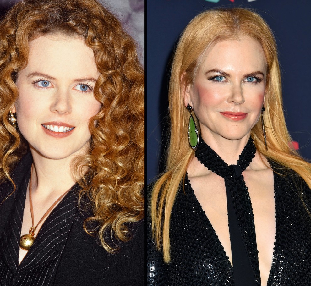 Nicole Kidman: Čeprav je Nicole še vedno brezčasna lepotica, so si v stroki lepotne kirurgije precej enotni. Nicole naj bi …