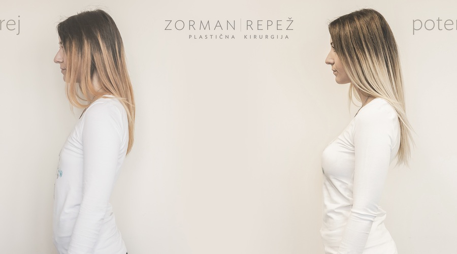 PREJ IN POTEM: Kaja na nobeni fotografiji ne nosi modrčka. Izbrani vsadki anatomske oblike so veliki 270 ml, kar je približno številko in pol več. (foto: gradivo Zorman - Repež)