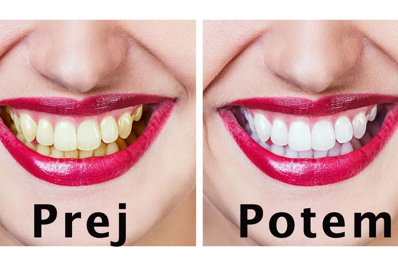 Top naravna maska za lepše in bolj zdrave zobe (foto: Profimedia)