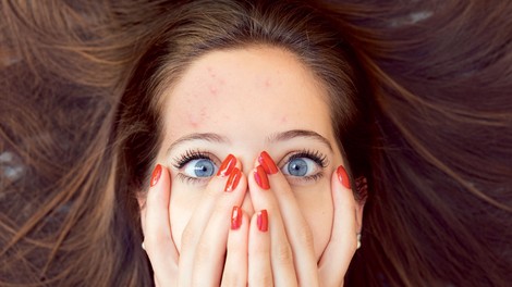 Znana lepotna blogerka razkrila, kako se znebiti mozolja v enem dnevu!