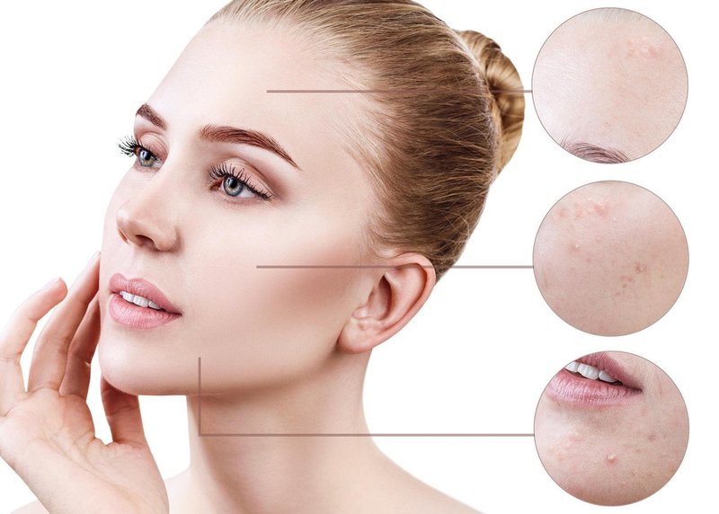 Področje aken na obrazu razkriva marsikaj o tvojem zdravju (foto: Profimedia)