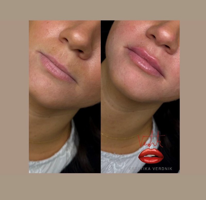 Lepota na varen način: kaj morate vedeti, preden se odločite izpopolniti videz s polnili za ustnice