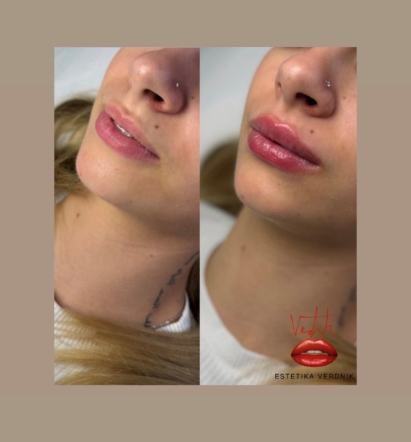 Lepota na varen način: kaj morate vedeti, preden se odločite izpopolniti videz s polnili za ustnice