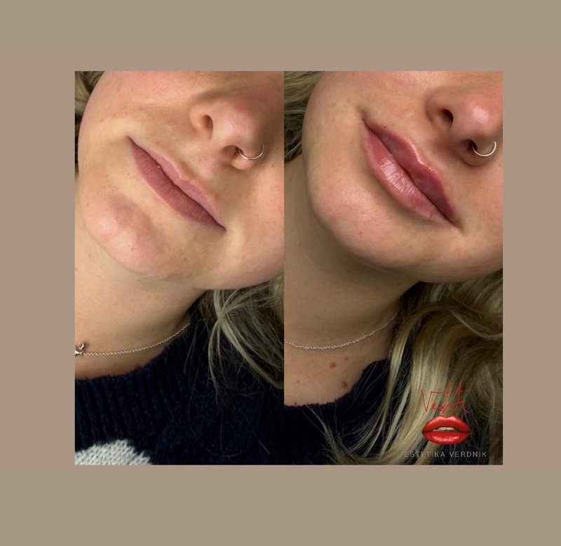 Lepota na varen način: kaj morate vedeti, preden se odločite izpopolniti videz s polnili za ustnice